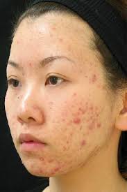 EBPB acne asian